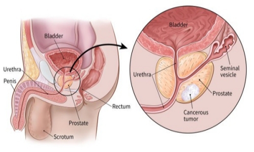ارثی بودن سرطان پروستات