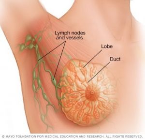 سرطان سینه تهاجمی